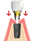 Abutment Placement