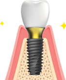 Final Crown Placement