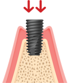 Implant Placement